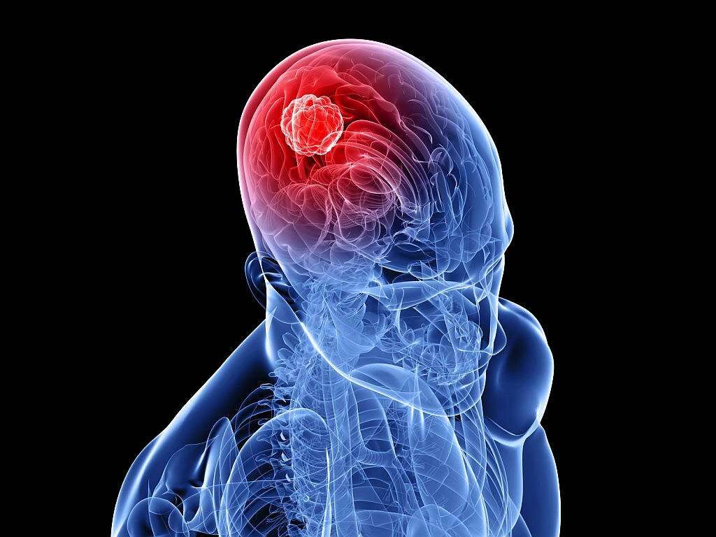 Head Tumor Head Tumor Symptoms