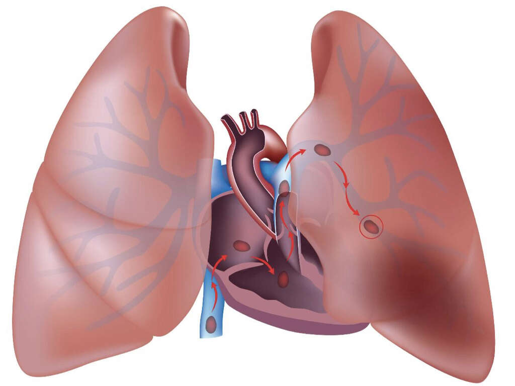  Causes of Pulmonary Embolism