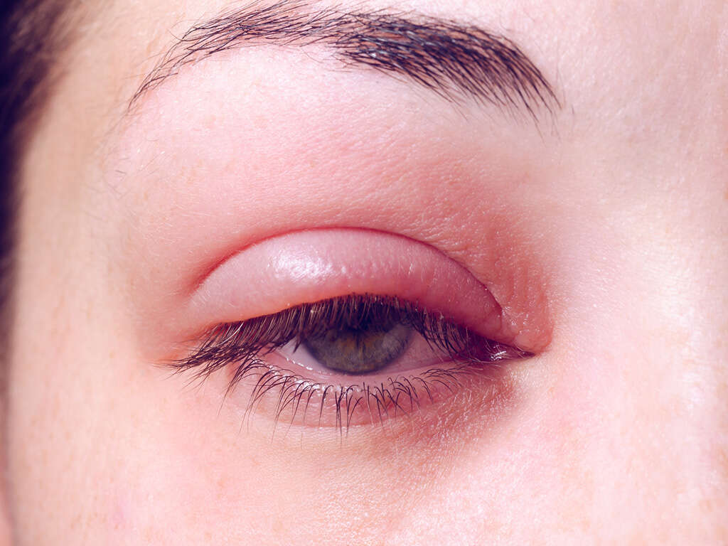 Swollen Eyelids