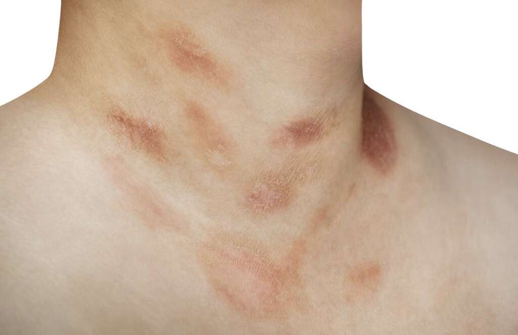 Pityriasis Rosea Facts