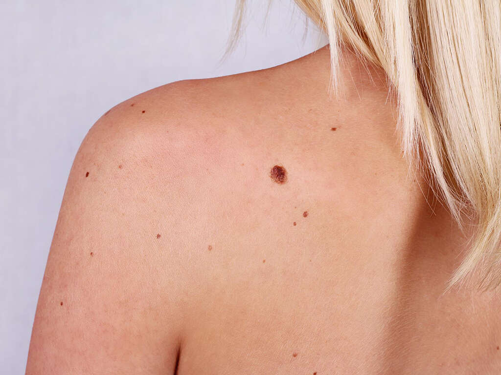 10 Symptoms of Skin Cancer