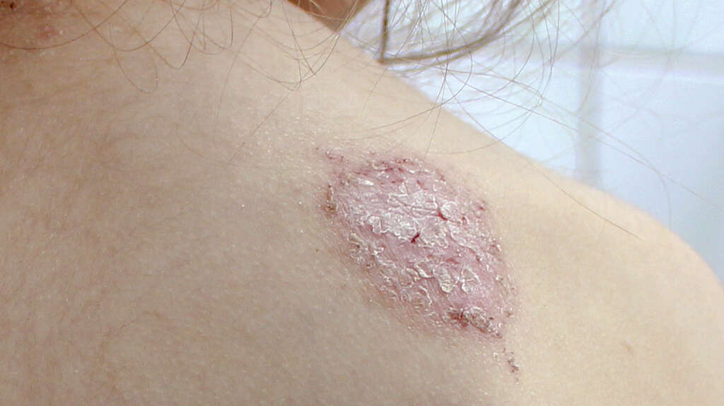 Discoid Eczema