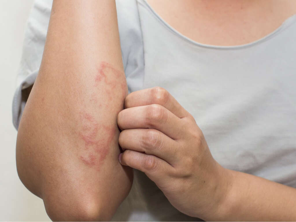 10 Symptoms Of Nummular Eczema