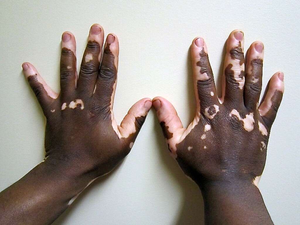 10 Causes of Vitiligo