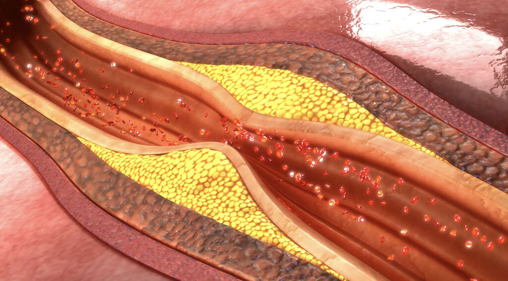 Clogged Arteries