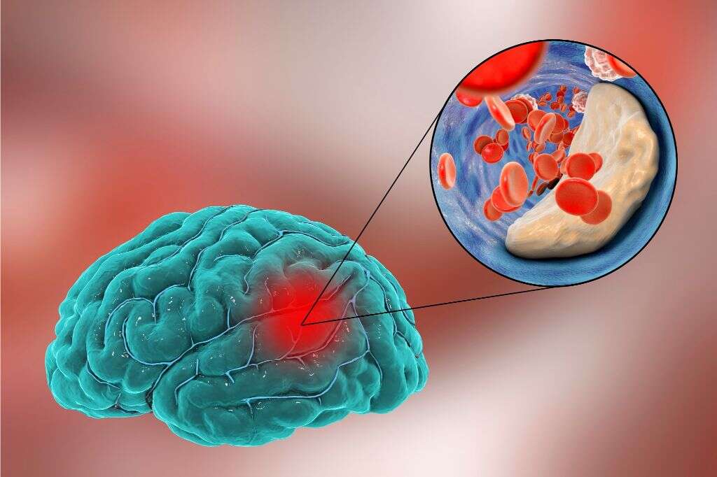 Ischemia