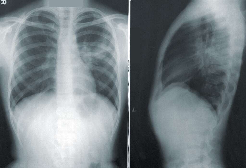 Achalasia