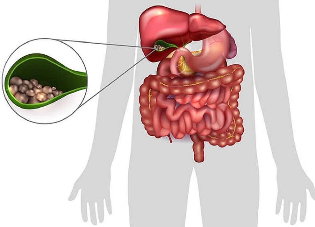 Choledocholithiasis