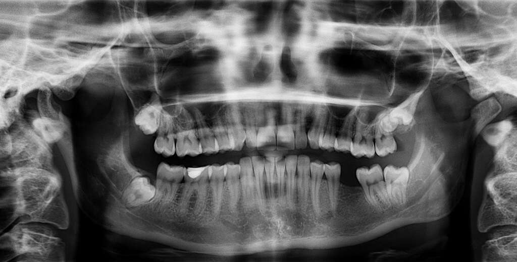 Cleidocranial Dysplasia