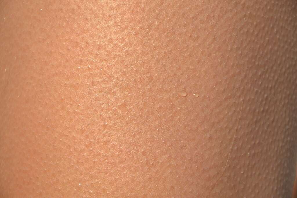 Fever