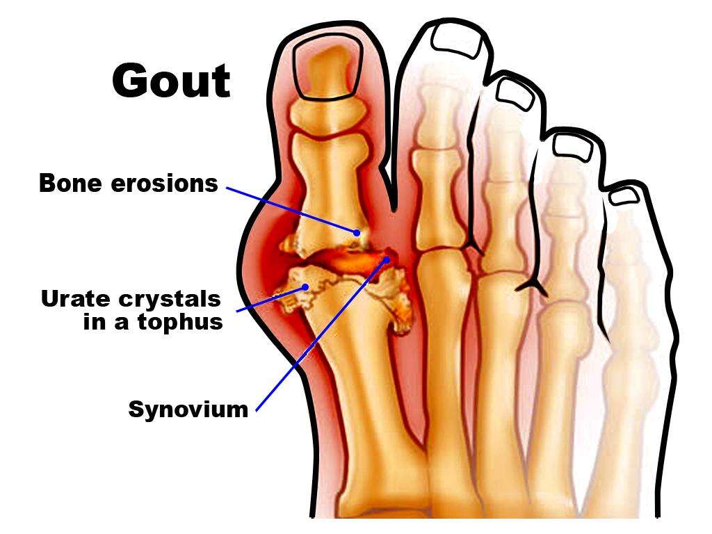 Gout