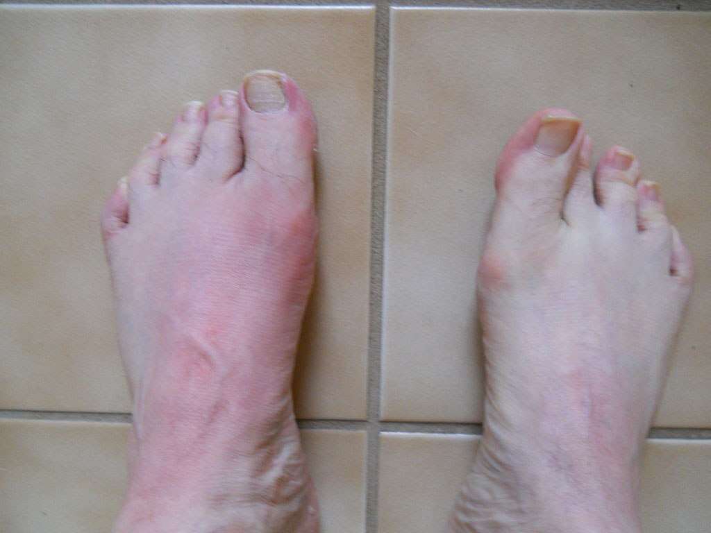 Gout