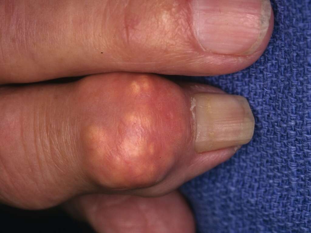 Gout