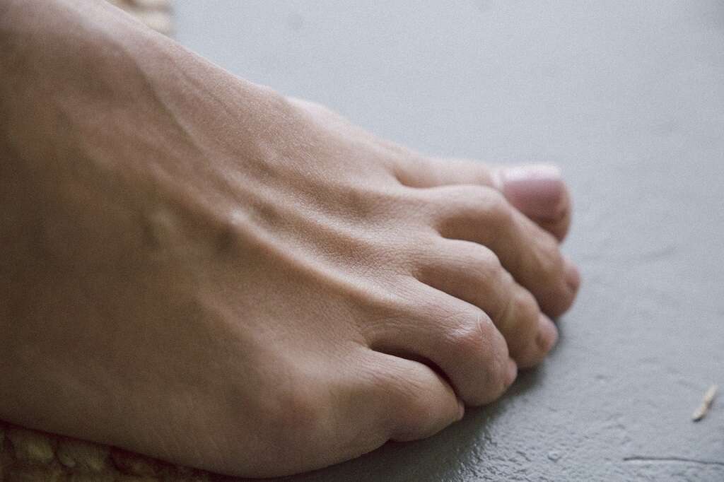 Hammer Toe