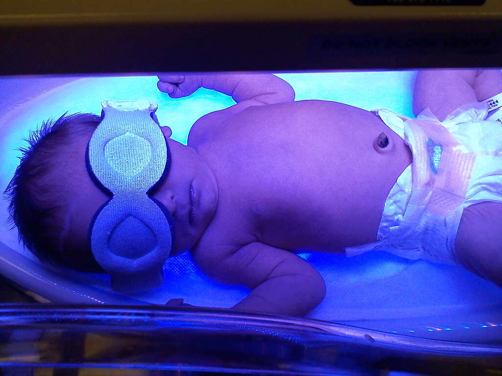 Jaundice