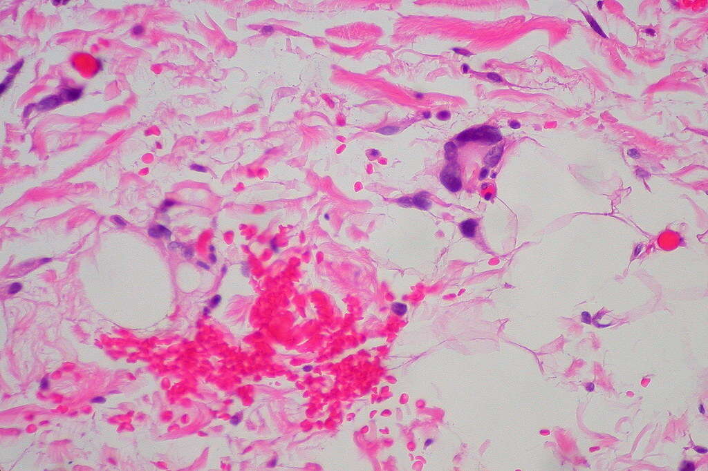 Lipoma