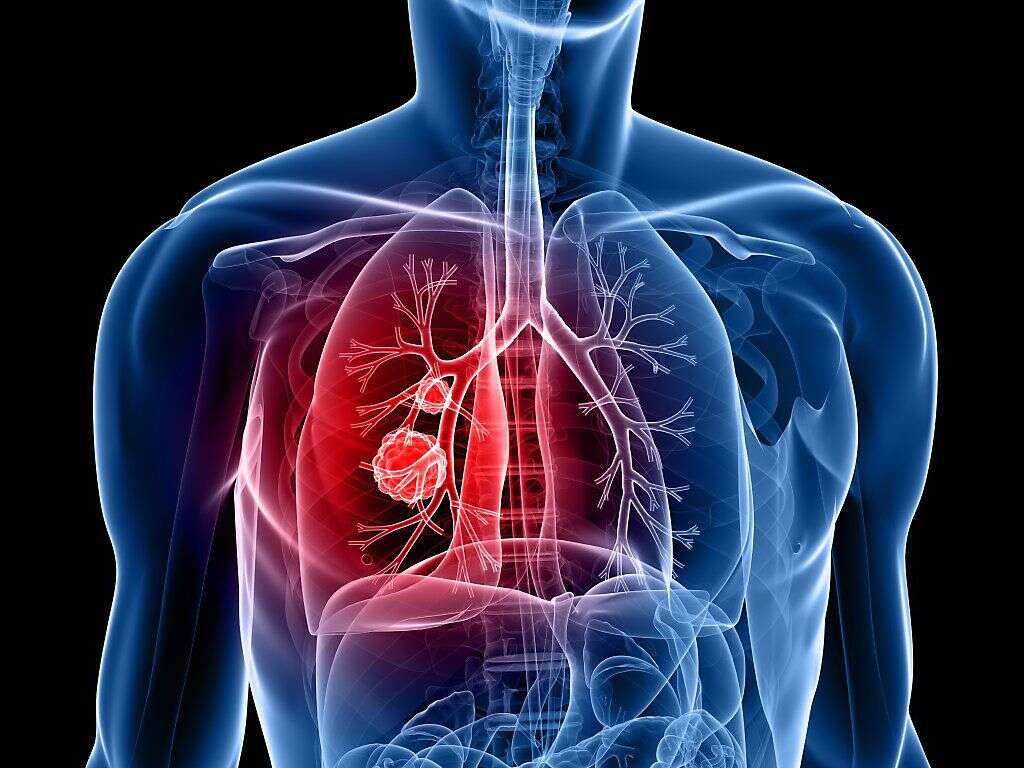 Lung Cancer