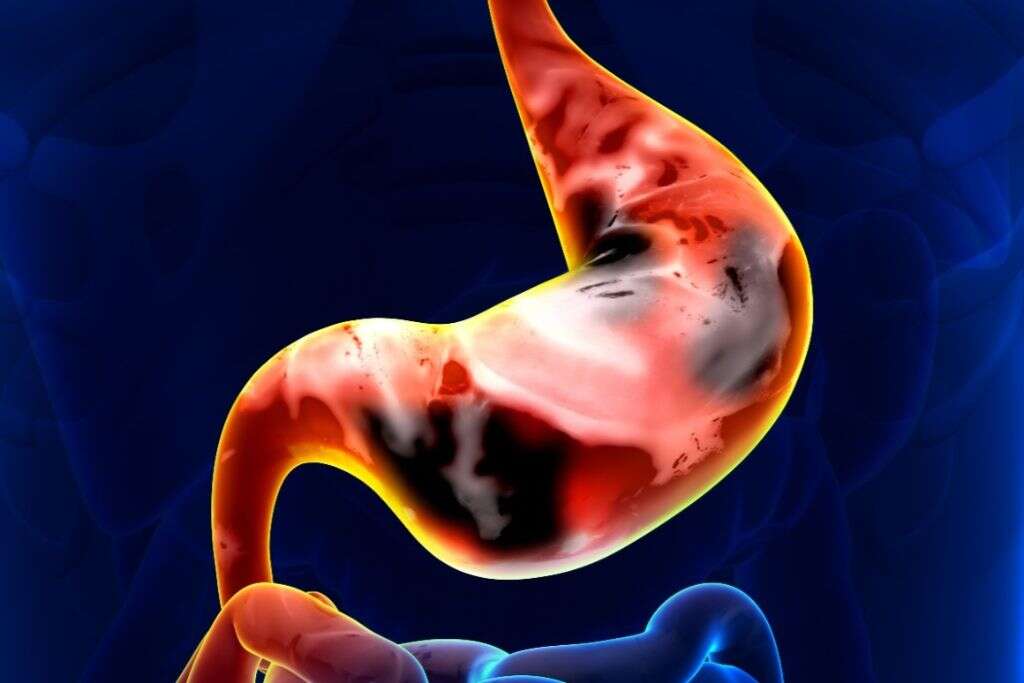Common Cancers