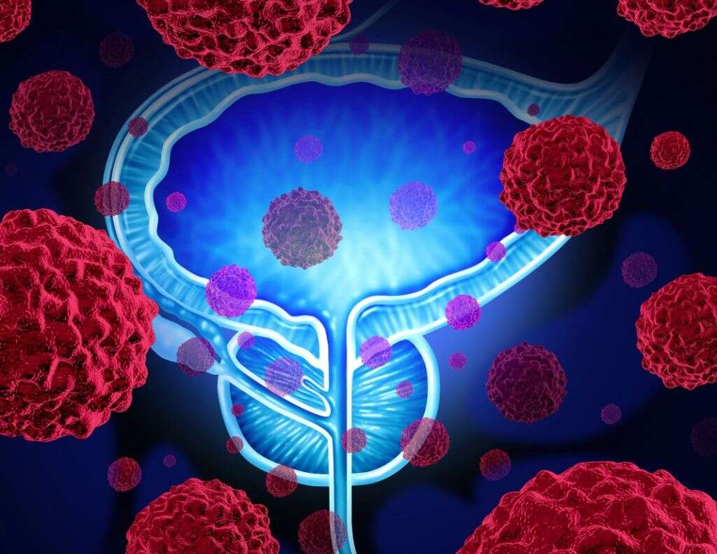 Common Cancers