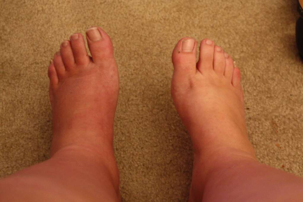 Orthopnea