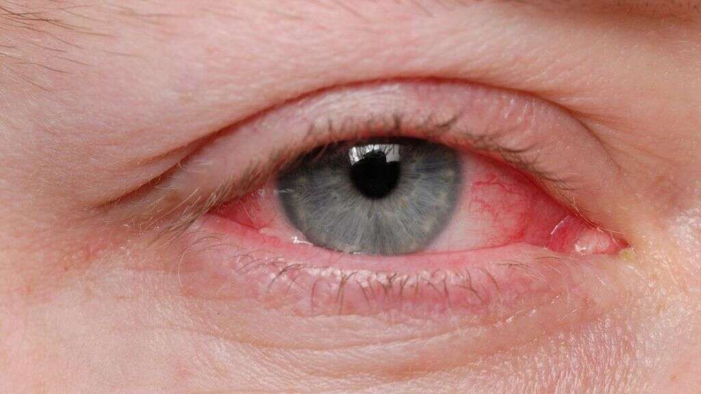 Pink Eye