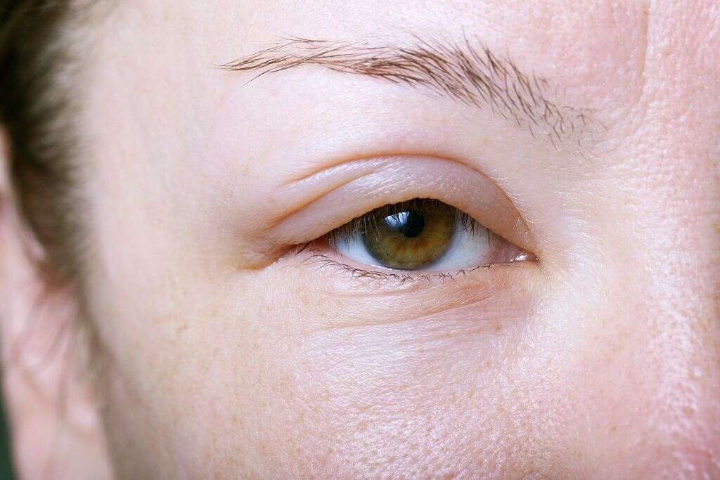 Pink Eye