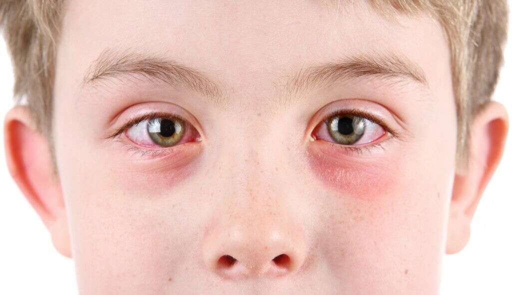 Pink Eye