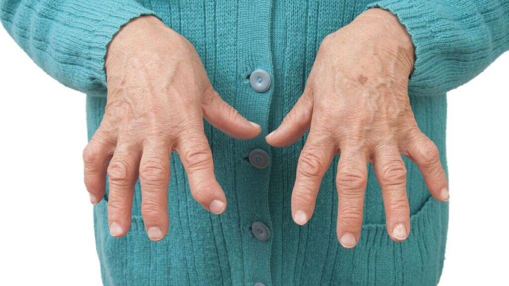 Rheumatoid Arthritis