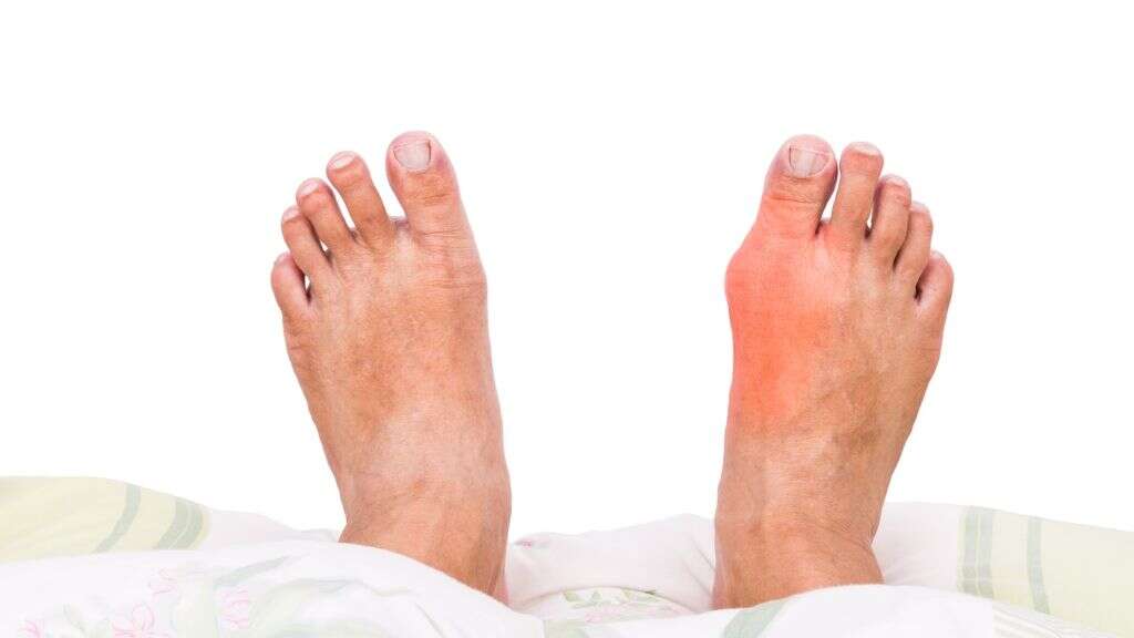 Rheumatoid Arthritis