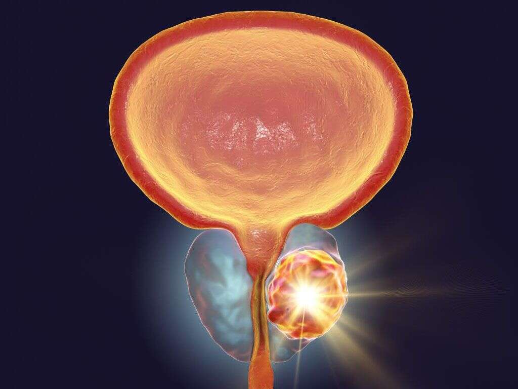 Prostate Cancer