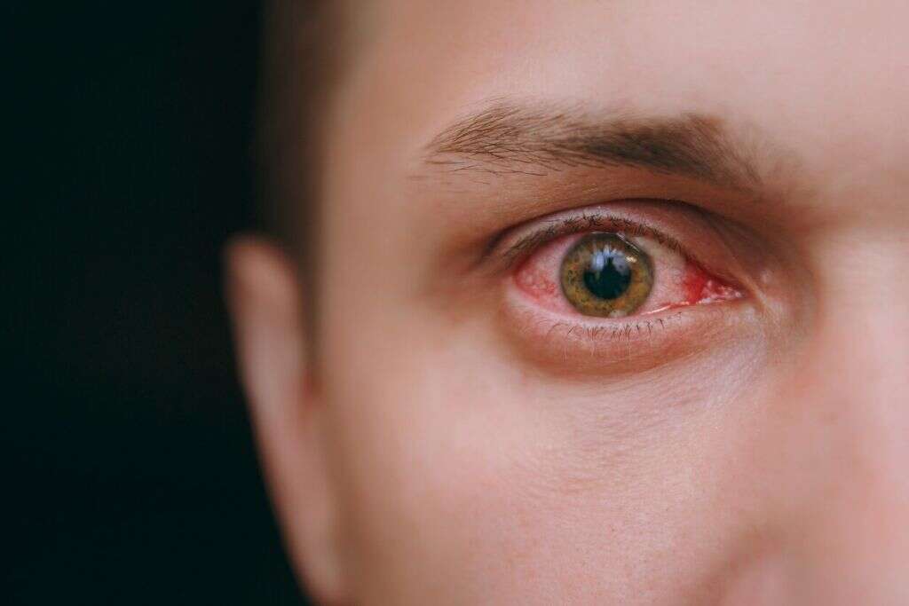 Chlamydia In Men