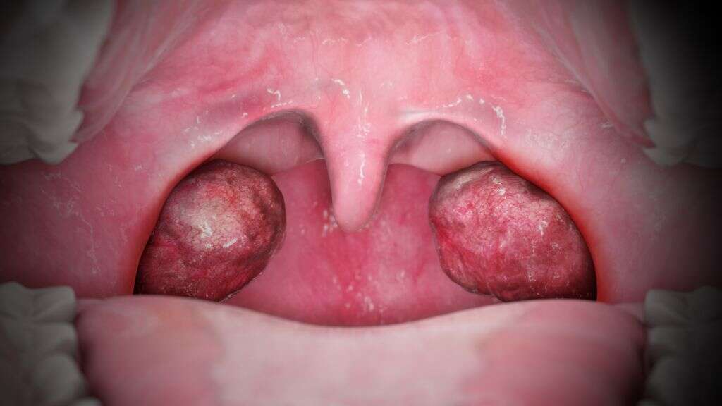 Tonsillitis