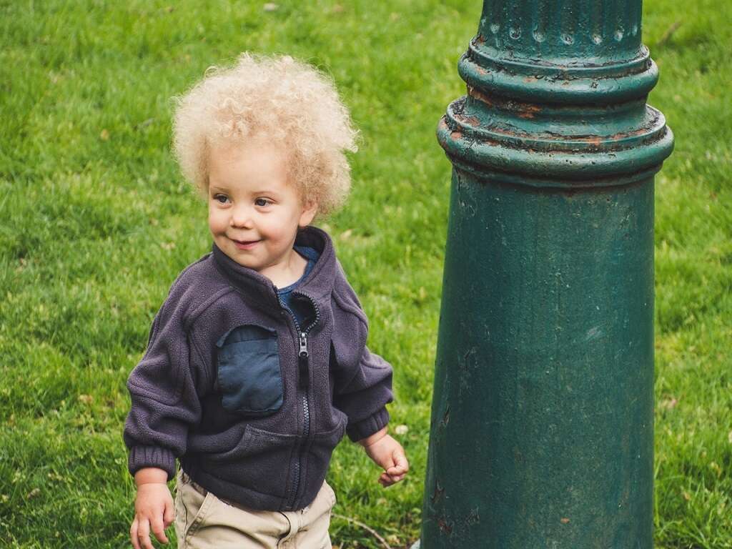 Uncombable Hair Syndrome