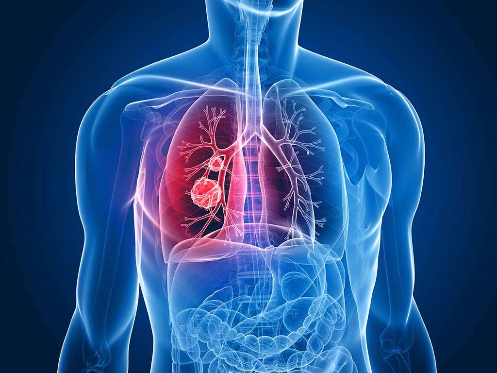 Acute Bronchitis