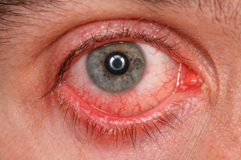 Eye Infections