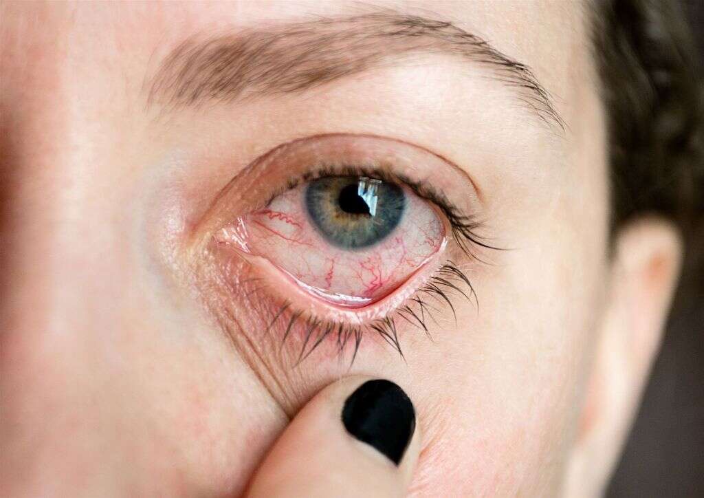Eye Infections
