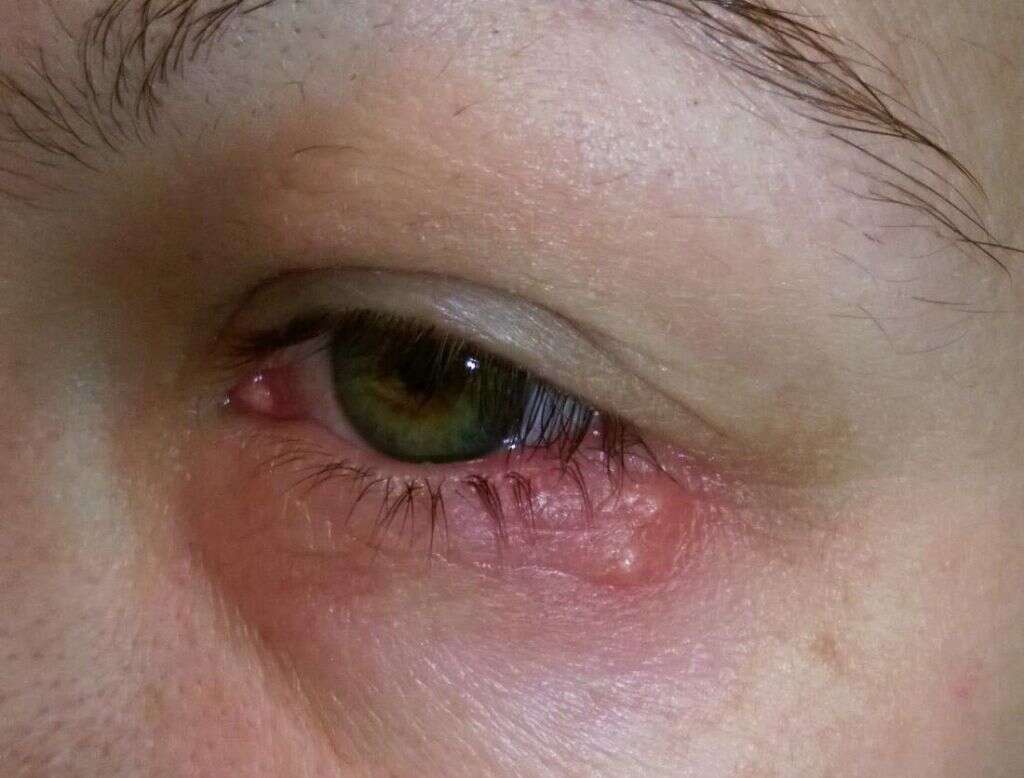 Eye Infections