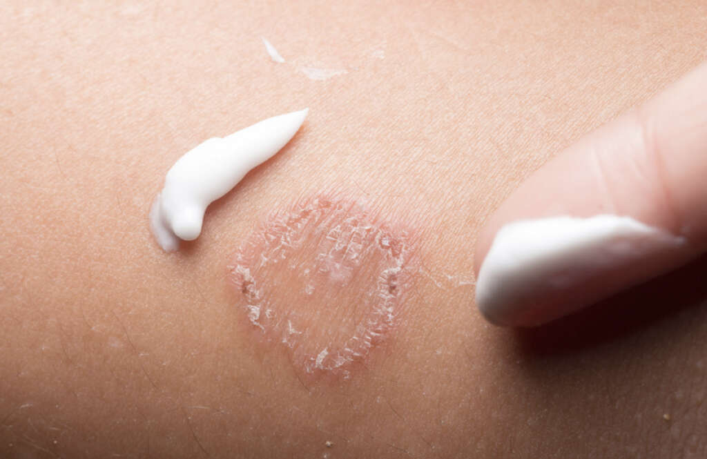 Ringworm In Humans