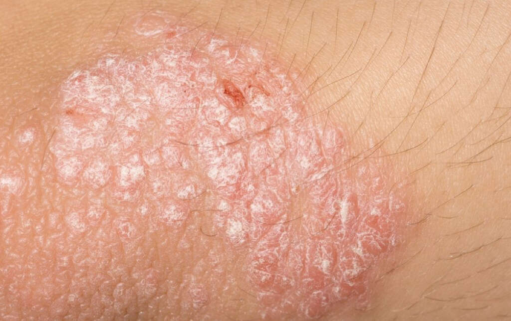 Ringworm In Humans