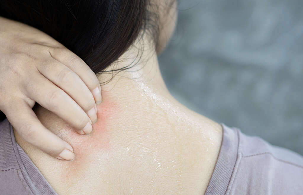 Ringworm In Humans