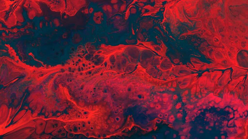 Anemia