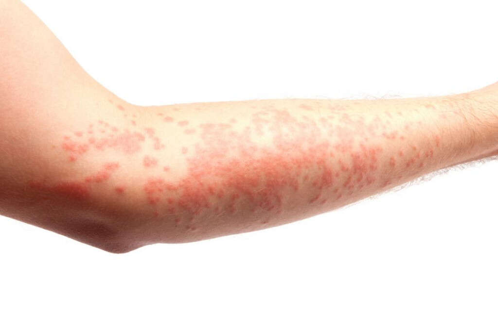 Angioedema