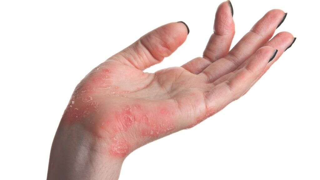 Ankylosing Spondylitis