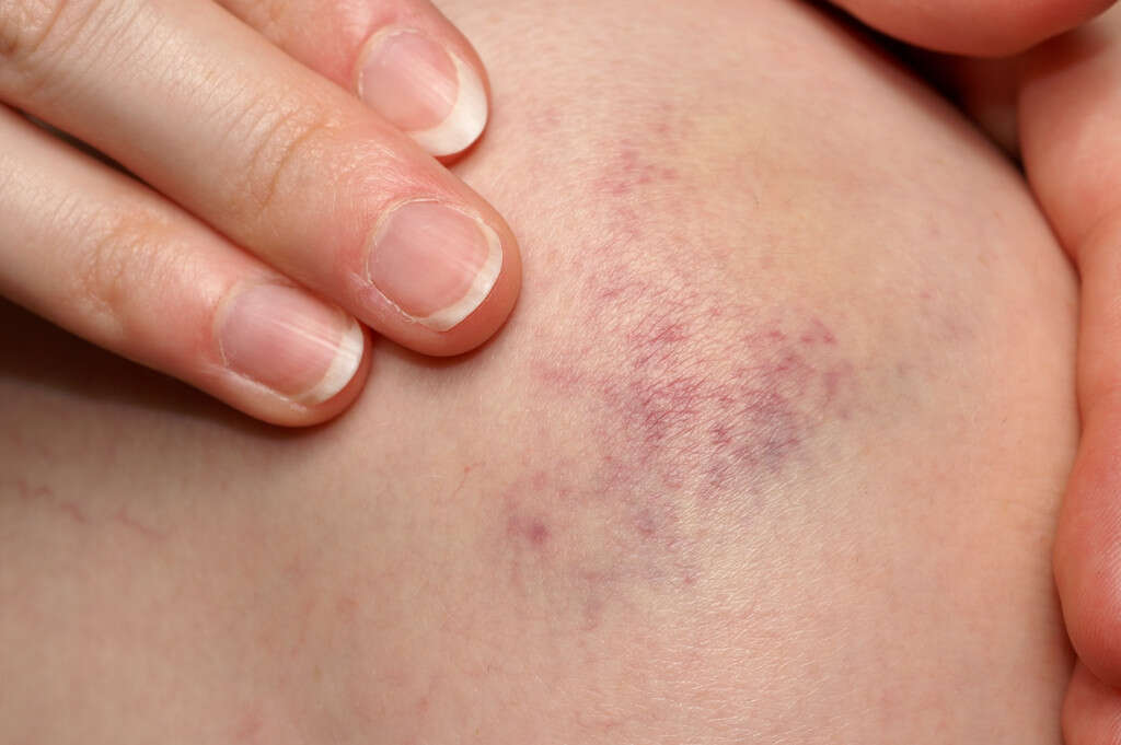 Aplastic Anemia