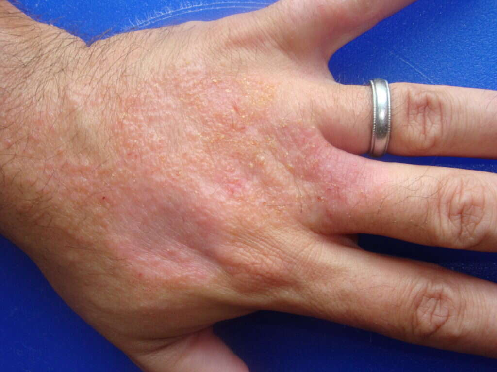 Atopic Dermatitis