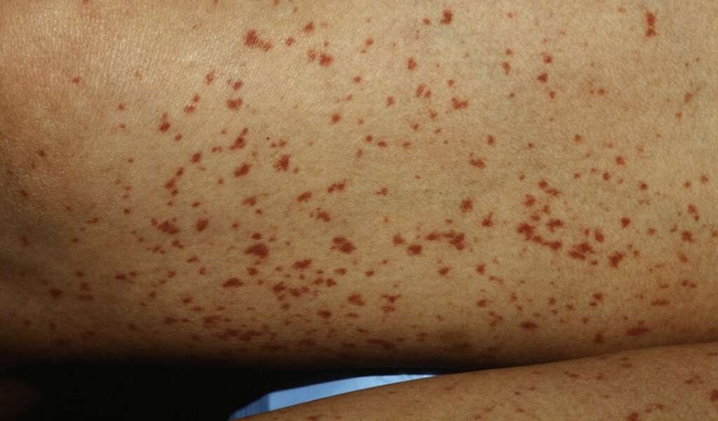 Autoimmune Disease