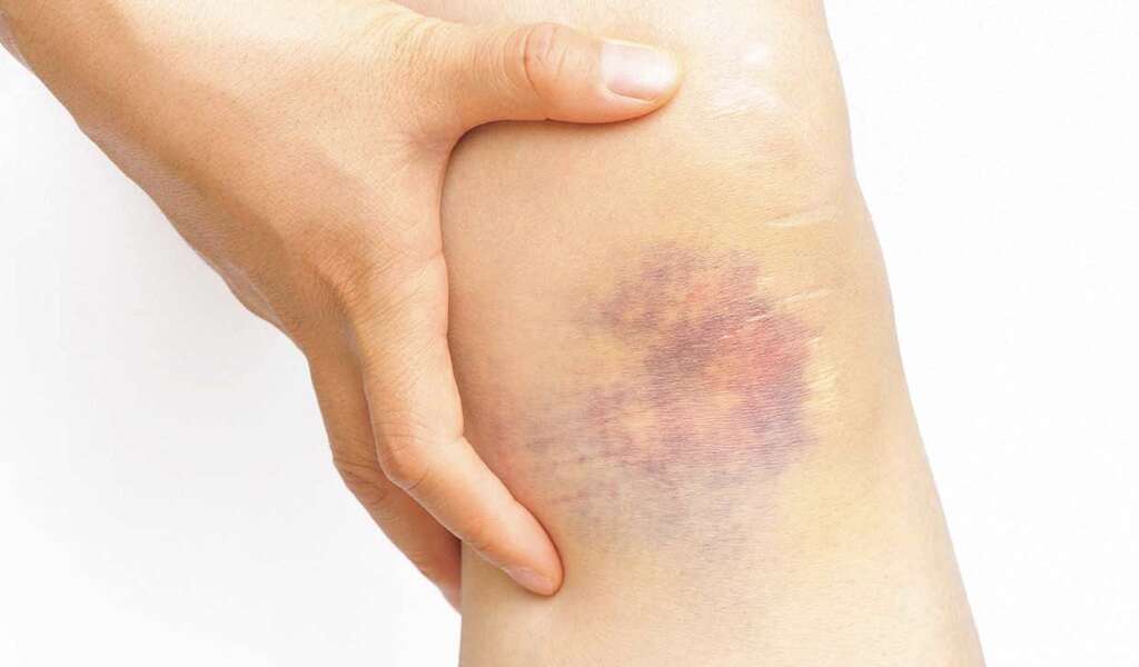 Baker's Cyst