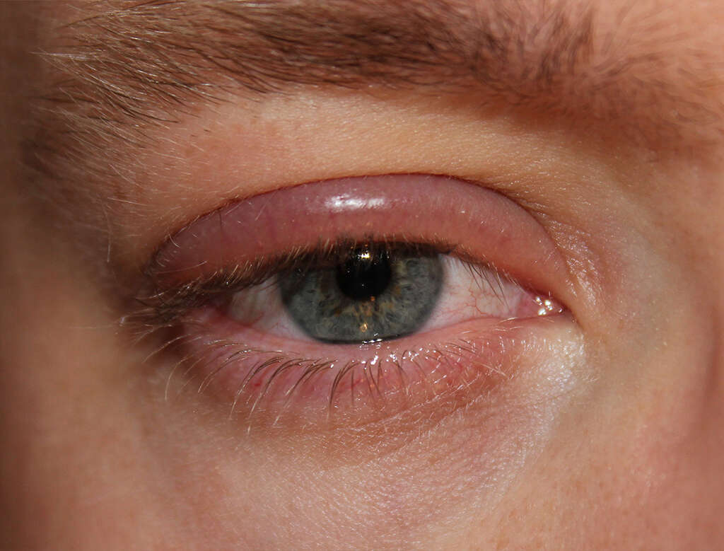 Blepharitis
