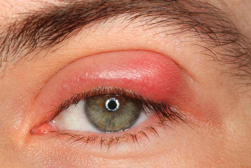 Blepharitis