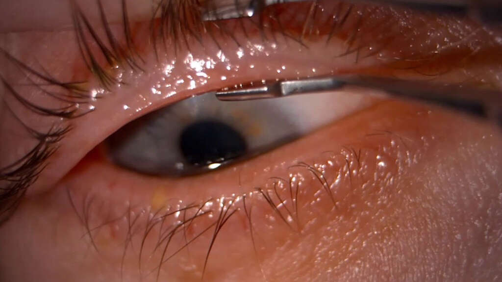 Blepharitis